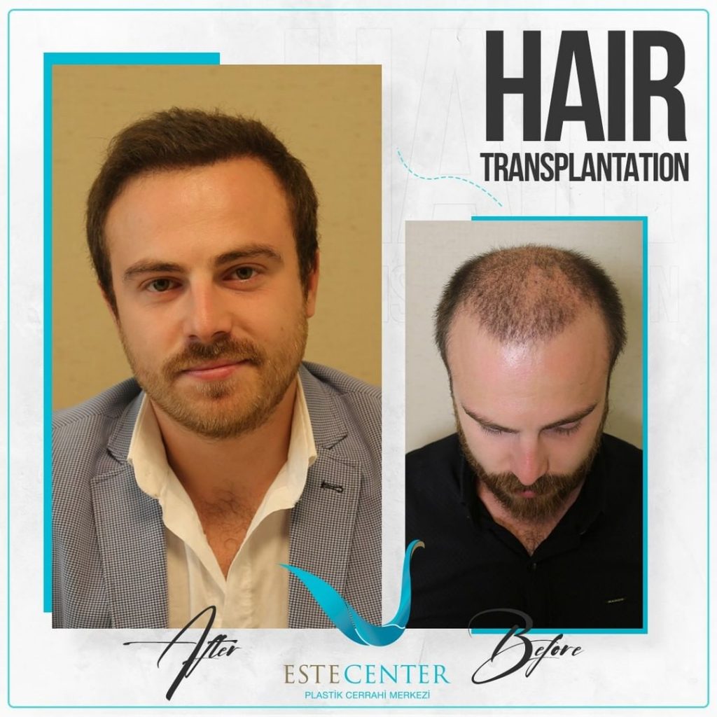 Is Turkey Good For Hair Transplant