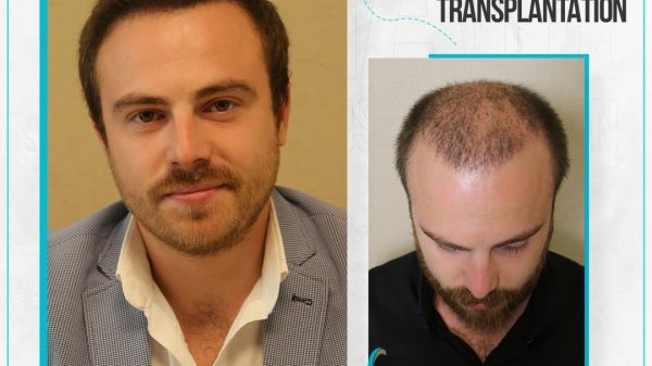 Hair transplant Turkey